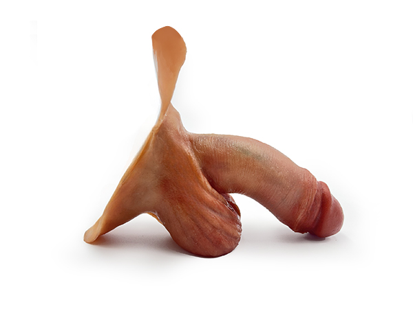 achille-prosthetics FTM Prostethics David